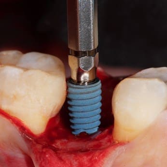 Implant zęba