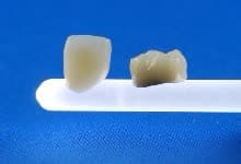Korona porcelanowa na cyrkonie. Korona porcelanowa na metalu Brzesko Bochnia
