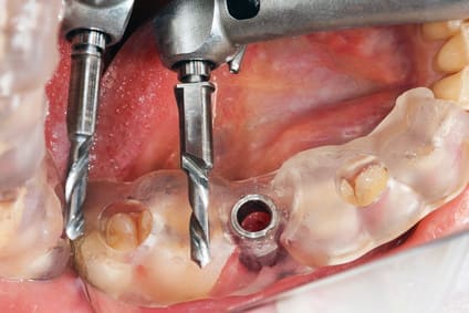 wkręcenie implantu. Szablon implantologiczny