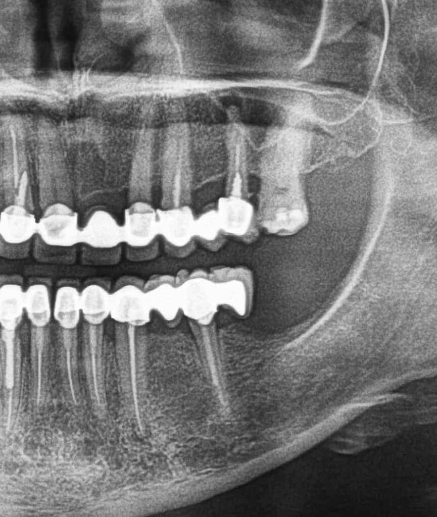 pantomogram protetyka