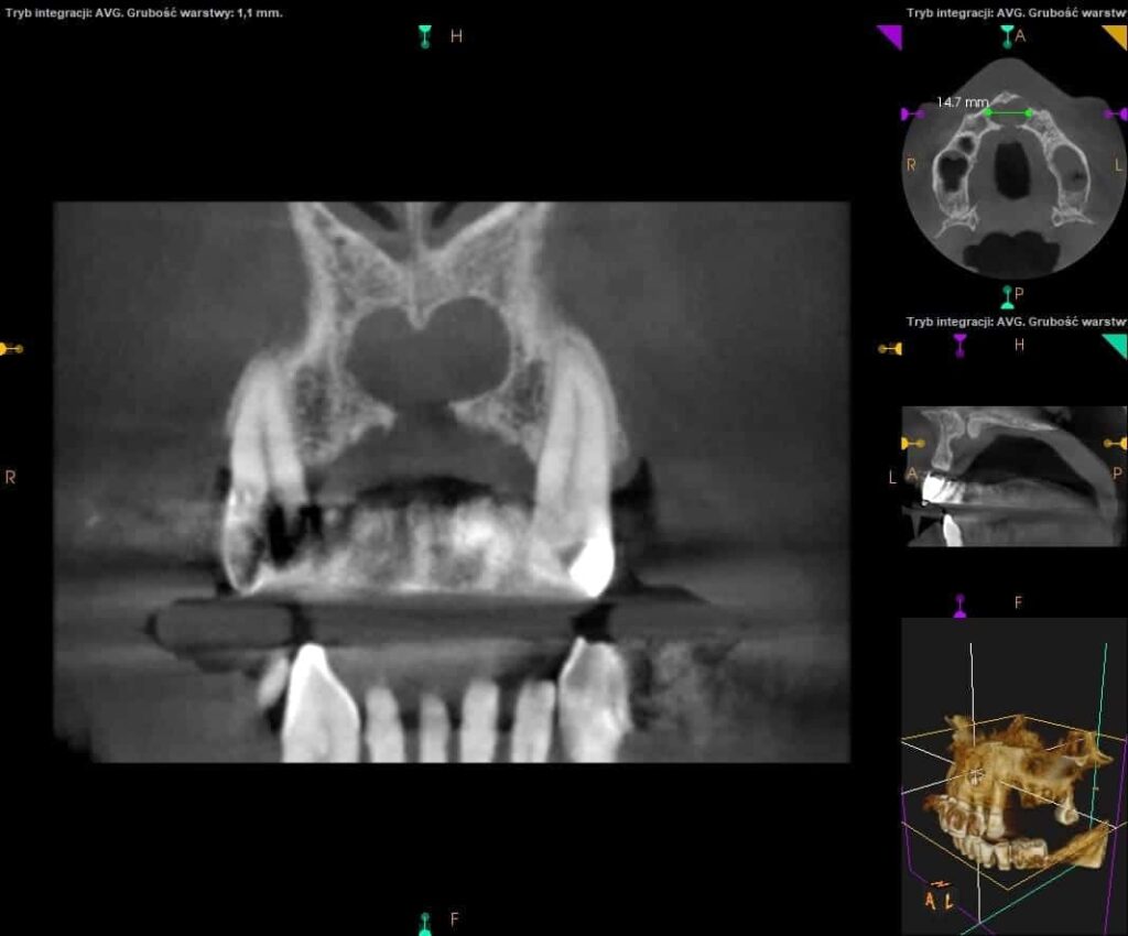 Zdjęcie tomograficzne CBCT szczęki górnej